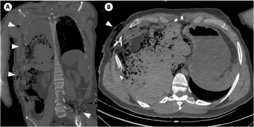 Figure 6. Coronal postmortem computed tomography (PMCT) image of the chest and abdomen (A) and axial PMCT image at the level of the upper abdomen (B) of a victim with multiple ballistic impact sites (arrowheads). Partially overlapping and dispersing trajectories complicate the identification of different ballistic trajectories.