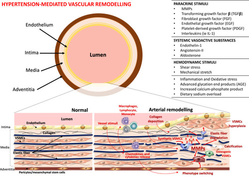 Figure 1 Pathological mechanisms of arterial wall remodelling. High blood pressure, by different stimuli, promotes several changes in the vessel wall of both large and small arteries, including recruitment and infiltration of inflammatory cells into the vessel wall, release of free radicals, proinflammatory chemokines, and cytokines, changes in vascular smooth muscle cells (VSMCs) (↑ cells hyperplasia and migration, ↑ VSMCs contraction and ↓ VSMCs relaxation, cells differentiation into osteogenic phenotype), endothelial cells (cells differentiation into osteogenic and VSMCs phenotype), elastic fiber degradation, collagen deposition, and calcification. The activity of several matrix metalloproteinases (MMPs) increases thereby contributing to development of arterial stiffness. Adapted from Van Varik BJ, et al. Mechanisms of arterial remodeling: Lessons from genetic diseases. Front Genet. 2012;3:290.  © 2012 van Varik, Rennenberg, Reutelingsperger, Kroon, de Leeuw and  Schurgers. This is an open-access article distributed under the terms of the Creative Commons Attribution License http://https://creativecommons.org/licenses/by/3.0/legalcode.Citation33