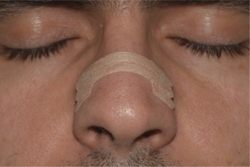 Figure 1 Front view of the external nasal dilator application site.