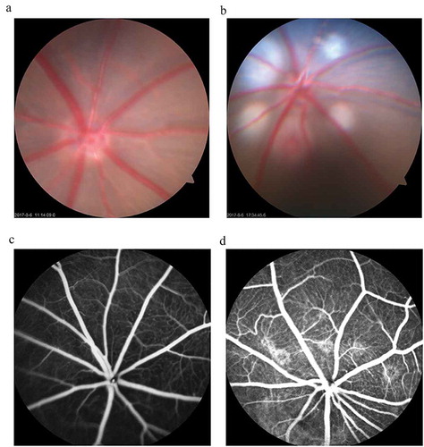 Figure 1. CNV rat models were successfully constructed by krypton-argon laser photocoagulation.The results showed that, compared with the untreated rats (Figure 1(a)), there were five round white spots around the optic nerve head, which indicates that the Bruch’s membrane is disrupted and five bubbles are formed successfully (Figure 1(b)). At day 14 after photocoagulation, fundus fluorescein angiography (FFA) was performed to evaluate CNV formation. The fluorescein leakages of the fundus indicate that angiogenesis networks are formed in the laser-treated rats (Figure 1(d)) compared with the untreated ones (Figure 1(c)).
