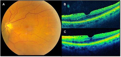 Figure 1 This 70-year-old male patient demonstrates a typical idiopathic epiretinal membrane with central macular involvement and minimal retinal thickening. The initial best-corrected visual acuity (BCVA) was 20/30 and the final BCVA was 20/30. (A) Fundus photograph; (B) baseline OCT image, horizontal cut; (C) final OCT image with wrinkles after 15 months of follow-up.