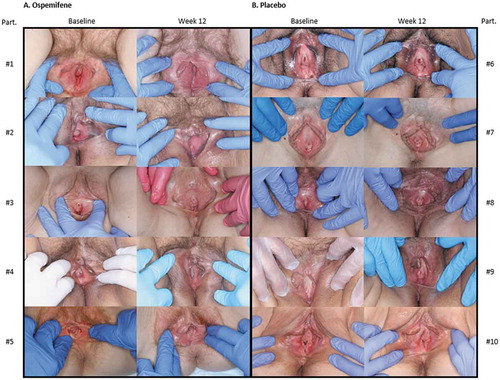 Figure 2. Representative vulvar and vestibular photographs for the Vulvar Imaging Assessment Scale (VIAS) of participants before and after ospemifene (on the left; A) and before and after placebo (on the right; B) for 12 weeks. Images from baseline to week 12 for participants randomized to ospemifene (A) show a greater amount of pink vestibular tissue with reduced pallor and reduced erythema, as well as less protrusion of the urethral glans tissue and less introital stenosis. Participant 1 also had an increase in the labia minora tissue. All images from baseline to week 12 of placebo-treated patients on the right (B) show no improvement or worsening of the vestibular pallor and erythema, protrusion of the urethral glans tissue, and introital stenosis; none had an increase in the labia minora tissue. Part., Participants. Reprinted with permission from Goldstein et al 2019 [Citation55].