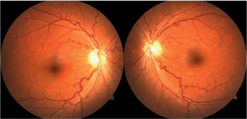 Figure 1 Fundus photographs showing veins are convoluted and slightly dilated, but arteries have straight courses.