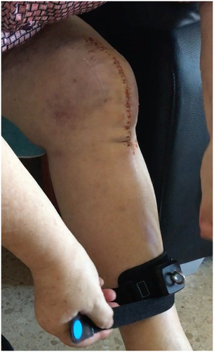 Figure 4. Patient wearing the ReHub® sensor on the shin to prepare for another exercise.