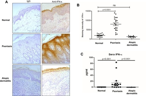 Figure 1 IFN-κ protein expression is increased in psoriasis lesions and sera. (A) Representative pictures of IFN-κ staining in normal skin, psoriasis lesions and AD lesions. IFN-κ protein is stained as brown color. Magnification x 200. (B) Semi-quantification analyses of IFN-κ protein staining intensity in normal skin (n=20), psoriasis lesions (n=20) and AD lesions (n=10). (C) IFN-κ in normal (n=17), psoriasis (n=17) and AD (n=10) sera. Statistical analyses were Wilcoxon rank-sum test for (C).