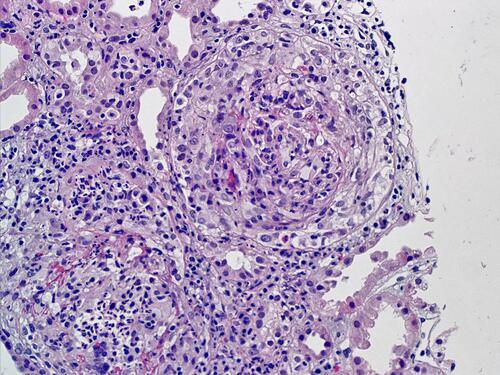 Figure 3 Light microscopy of the renal biopsy featuring cellular crescents in both the glomeruli, and a large number of inflammatory cells within. There is extensive destruction of the glomerular tufts (Hematoxylin and Eosin staining; magnification 300 X).