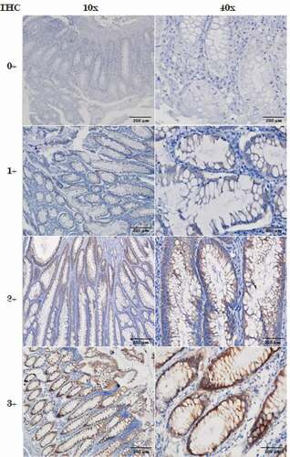 Figure 1. IHC staining images with (0, 1+, 2+, 3+) different scoring, were the 0, 1+ considered to be negative and 3+ considered to be positive