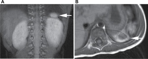 Figure 2 (A) Coronal and (B) axial abdominal magnetic resonance images show a 1 cm soft-tissue density (arrows) that was thought to be a hypoplastic spleen in the normal location of the spleen.