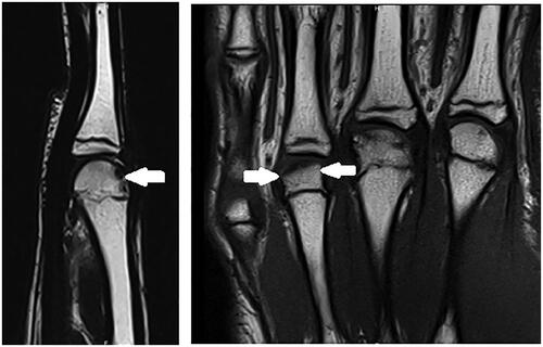 Figure 6. Third MRI January 2023. Apparition of signal abnormality of the fourth metacarpal head in the MRI T1 weighted images.