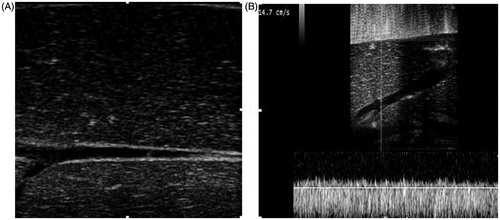 Figure 2. Grey-scale and colour Doppler ultrasound images of the perfused liver. (A) Grey-scale image after perfusion. The perfused liver parenchyma was homogeneously hypoechoic, the intrahepatic vessels were clear and regular, and the vascular wall was smooth. (B) Normal spectrum of the portal vein after perfusion with colour Doppler ultrasound imaging with a mean velocity of 14.7 cm/s.