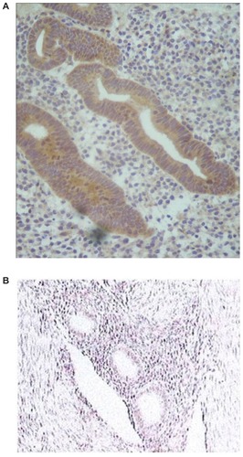 Figure 5 Positive aromatase expression in the eutopic endometrium of a patient with adenomyosis (A) and negative expression in a patient after using a Mirena® device for 5 years (B).