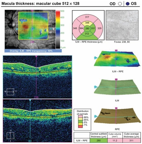 Figure 6 Optical coherence tomograph for the same patient in group 1 at the 12-month visit.