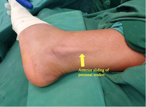 Figure 2 Peroneal tendon dislocation visible outside the peroneal groove. The dislocation was manipulated manually by surgeon while patient was under sedation preoperation.