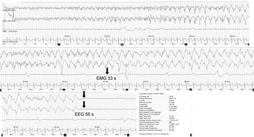 Figure 3 An adequate therapeutic seizure in the 16th session (right unilateral ultrabrief pulse ECT, Low 0.25, 100%), which was associated with high-amplitude slow waves and postictal suppression on the ictal electroencephalogram.