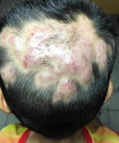 Figure 1 Dermatological examination showing multiple erythematous nodules with sinuses on the scalp of the parieto-occipital area and alopecia.