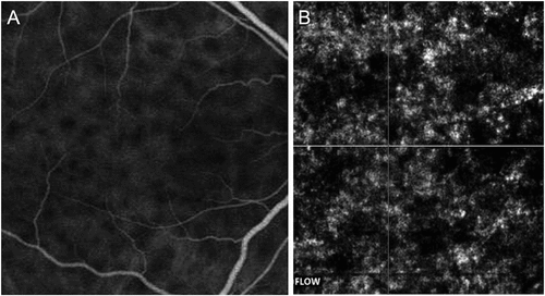 Figure 5. Indocyanine green angiography (ICGA) (A) and optical coherence tomography angiography (OCTA) (B) of a patient with active Vogt–Koyanagi–Harada’s (VKH) disease. The ICGA shows areas of hypofluorescence suggestive of choroidal granulomas characteristic of VKH disease. The corresponding OCTA of the choriocapillaris layer shows hypo-reflective areas that exactly co-localize with the hypofluorescent areas on ICGA, suggestive of true flow deficit areas in the choriocapillaris slab.