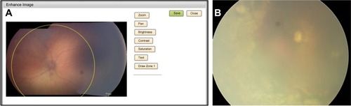 Figure 2 Computerized Zone 1 determination.