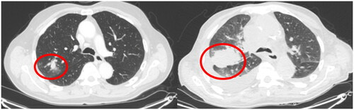 Figure 4. Example of infiltrate in right upper lobe that did not receive follow-up. Computed tomography examinations taken 10 months apart. Diagnosed with T4N2M1c small cell carcinoma.