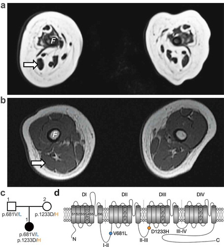 Figure 1. Whole exome sequencing identifies two CACNA1H missense mutations associated with severe congenital amyotrophy. (a) Whole-body magnetic resonance T1 weighted images (T1W1) 3T (axial view) of the thigh at 6 weeks old revealed severe muscle amyotrophy. No muscle was visualized in the anterior compartment. Her right biceps femoris (arrow) measured 8 × 5 mm at its widest. (b) For comparison, a T1WI (axial view) from a hypotonic boy with nemaline myopathy was performed at 4 months old. His biceps femoris measured 14 × 9 mm. F: femur. (c) Family pedigree chart. Filled and open symbols indicate affected and unaffected individuals, respectively. (d) Location of the p.V681L (blue circle) and p.D1233H mutations (orange circle) within the secondary membrane topology of Cav3.2 channel.