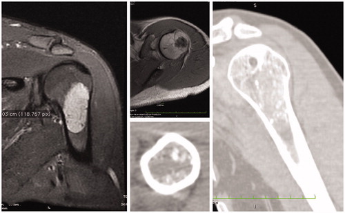 Figure 1. Preoperative MRI and CT scan showing a low-grade chondrosarcoma of the proximal humerus. Images demonstrate that a wide minimal resection sparing the joint is technically possible.