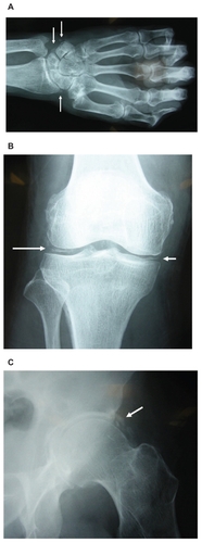 Figure 2 The radiographs of the patient with pseudogout demonstrated chondrocalcinosis (arrows) on the wrist A), knee B), and hip C).