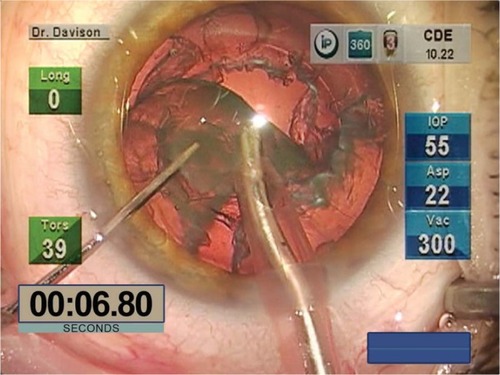 Figure 3 Video freeze frame of third quadrant removal.