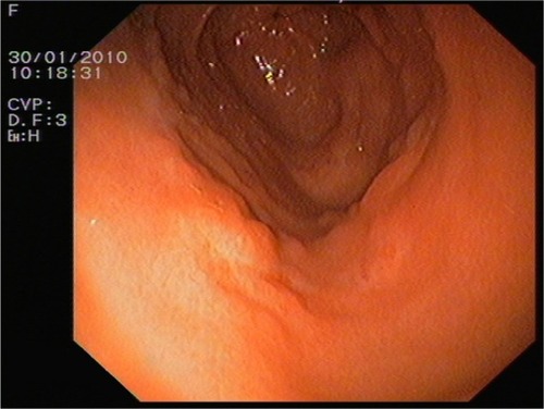 Figure 1 Endoscopic image of gastric mucosa with granular mucosa with adenomatous pattern.