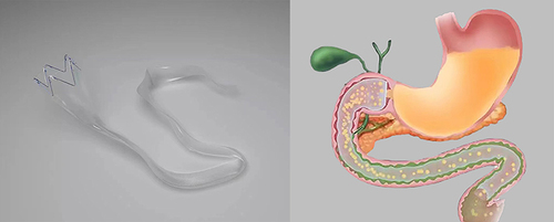 Figure 1 The duodenal-jejunal bypass liner (left)—and in situ (right) (Supported by Tongee Medical Technology Co. Ltd).