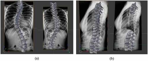 Figure 6. An illustrated view of back projection of 3D model over frontal X-ray and lateral X-ray (b)