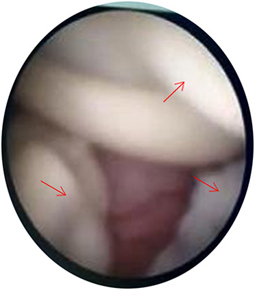 Figure 2 The red arrow symbol represents the fungal infection in the renal pelvis in the surgical field.
