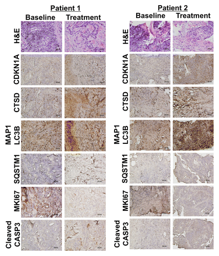 Figure 4. HCQ and VOR trigger intratumoral increases in the levels of CDKN1A, CTSD, and LC3-II. Effects of treatment on the expression of key biomarkers of HCQ and VOR in tumor specimens. Tumor biopsies were collected at baseline and post-treatment on d 49 from 2 patients with colorectal cancer (Patient #1 = unmutated RAS, Patient #2 = mutant KRAS). Immunohistochemistry was utilized to assess the levels of CDKN1A, CTSD, and LC3-II as described in Patients and Methods. Hematoxylin and eosin staining was conducted to visualize tumor architecture.