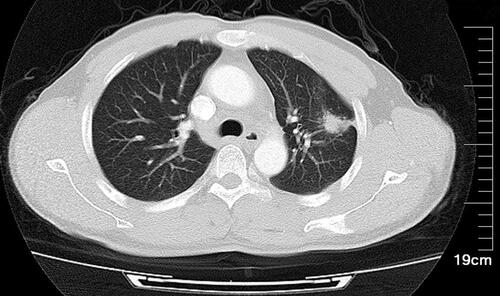 Figure 1 A 16-slice computed tomographic scan revealed a left lung nodule superior lobe (2.8×1.2 cm) anterior segment. The nodule had a spiculated sign, pleural indentation, vessel convergence, and multiple burr shadows on the edges.