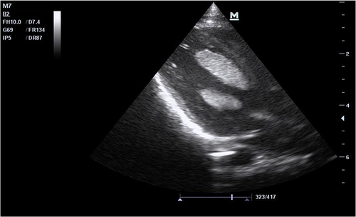 Figure 3 Left ventricular papillary muscle echogenic mass (rhabdomyoma) at one year of age.