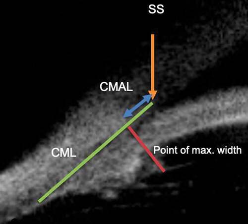 Figure 4. Figure depicting ciliary muscle length (CML) and ciliary muscle anterior length (CMAL). SS: scleral spur.