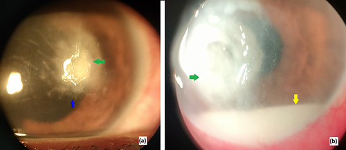 Figure 2 Clinical signs differentiating fungal corneal ulcer (a) from bacterial (b). The signs are infiltration (Green arrow), feathery borders (blue arrow), and hypopyon (Yellow arrow).