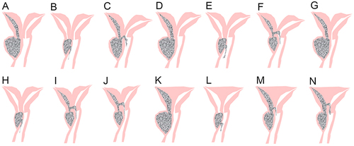 Figure 1 Anatomical illustrations of the utero-cervical-vaginal anatomy in type I UGTOIRA syndrome (vaginal obstruction).Complete bicorporeal uterus, double cervix without cervical obstruction, and low oblique vaginal septum, without communication (A), with a foramen in the oblique vaginal septum (B), with a fistula connecting the oblique vaginal septum and the contralateral cervix (C); complete bicorporeal uterus, septate cervix without cervical obstruction, and low oblique vaginal septum, without communication (D), with a foramen in the oblique vaginal septum (E), with a fistula in the cervix septum (F); partial bicorporeal septate uterus, septate cervix without cervical obstruction, and low oblique vaginal septum, without communication (G), with a foramen in the oblique vaginal septum (H), with a fistula in the cervix septum (I), with communication between both internal orifices of the cervix (J); complete septate uterus, septate cervix without cervical obstruction, and low oblique vaginal septum, without communication (K), with a foramen in the oblique vaginal septum (L), with a fistula in the cervix septum (M), with communication between both internal orifices of the cervix (N).