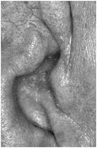 Figure 2. Skin in hypogonadism. The skin is thin and smooth; wrinkles are notably small and crinkling.