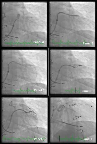 Figure 5. Access to the target vein in a patient undergoing CRT implant. Panel A: A vein selector is introduced. The take-off is sought by maneuvering the vein selector and injection of contrast dye (anterior-posterior projection).Panel B: The target branch is identified, and the vein selector is located in the proximal part of the vein.Panel C: A PCI wire is introduced in the vein selector. Panel D: An additional PCI wire is introduced and the LVI is telescoped in the vein. Panel E: A small volume of contrast dye is injected to ensure the distal part of the vein when the tip of the lead is expected to reach its final destination.Panel F: Final position of the lead (right anterior oblique projection).