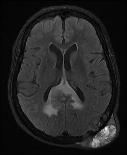 Figure 2 Magnetic resonance imaging (T2-weighted axial image) showing diffuse dural mass and another large lesion in the left occipitoparietal bone with intracranial extradural, intraosseous, and subgaleal soft tissue components.