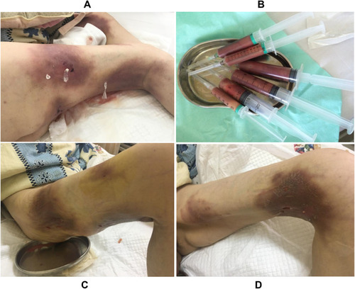 Figure 3 Treatment with cutting the abscesses and lavaging the abscess cavities with fluconazole saline solution (A). A large amount of pus from the abscesses (B). Inflammation within the skin lesions was obviously improved after a week of treatment (C and D).
