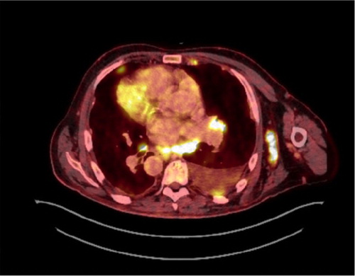 Fig. 2 Chest PET-CT scan showing no sign of a primary lung lesion but multiple enlarged lymph nodes, a left-sided compression atelectasis, and ipsilateral pleural effusion.