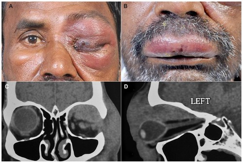 Figure 4 External photograph of the patient showing periocular edema with total ptosis, skin induration, and blisters, as well as lip edema and blisters. External photograph of the patient showing left periocular edema with total ptosis, skin induration, and blisters (A). External photograph showing upper lip edema with blisters (B). CT scan coronal cut of the same patient shows a diffuse ill-defined mass involving the entire superior orbit with superolateral bony erosion and extension into the temporal fossa (C). CT scan with sagittal reconstruction showing diffuse mass involving the entire superior quadrant up to the apex with indentation of the globe and optic nerve stretch (D).