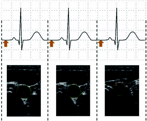 Figure 2. ECG signals with highlighted trigger points.