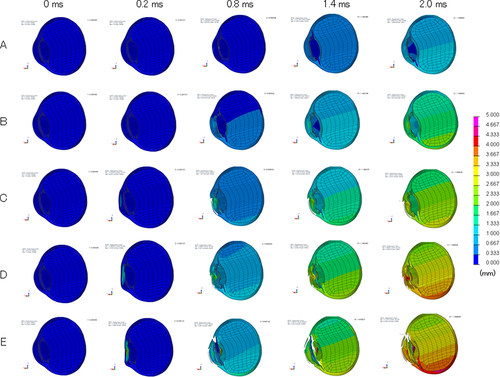 Figure 2 Sequential deformity of hyperopic eye upon airbag impact at five different velocities. Cases of impact velocities of 20 (A), 30 (B), 40 (C), 50 (D), and 60 m/s (E) in the normal-length model eye are shown. Results at 0, 0.2, 0.8, 1.4 and 2.0 ms after the impact are displayed. Axial deviation from the baseline position is displayed in each figure on a color-bar scale.