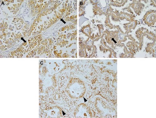 Figure 1 S100A16, E-cadherin, and vimentin expression in lung adenocarcinoma. (A) The majority of the tumor cells showed membranous S100A16 expression (arrows) in lung adenocarcinoma (×400 magnification). (B) Membranous staining of the tumor cells (arrows) was considered to be a positive result for E-cadherin (arrow, ×200 magnification). (C) Cytoplasmic staining of the tumor cells (arrow heads) was considered to be a positive result for vimentin (×200 magnification).