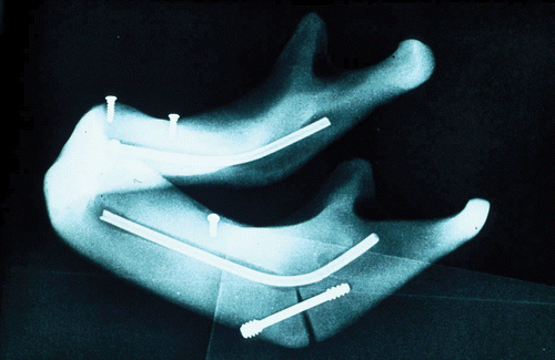 Figure 10. Postoperative X-ray of the mandibular model with inserted screw. [Color version available online.]
