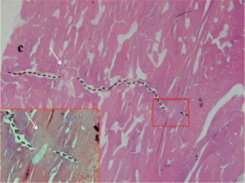 Figure 10. Incomplete atypical fracture, 18 months after cessation of bisphosphonate treatment. C periosteal callus. Dashed lines: fracture gap. White arrows: Remodeling within the fracture gap.
