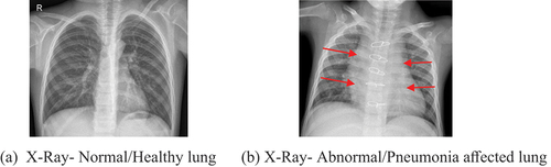 Figure 2. (A) X-Ray- Normal/Healthy lung (b)X-Ray- Abnormal/pneumonia affected lung.