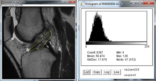 Figure 2 ACL tracing and resulting histogram.