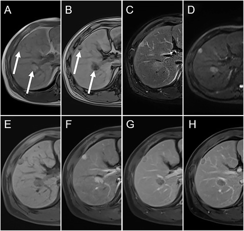 Figure 3 47-year-old man without pathological microvascular invasion. The serum α-fetoprotein was < 400 ng/mL. The Axial contrast-enhanced MR demonstrated two HCC lesions in the right liver section with the total diameter of 3.7 cm. Both lesions contained fat (A and B, white arrows) and demonstrated hyperintense on T2-weighted image (C), diffusion-weighted image (D) and hypointense on T1-weighted image (E). After the injection of contrast agent, both lesions showed typical enhancement pattern with enhancement on the arterial phase (F) and washout on the portal phase (G) and delayed phase (H). Both lesions showed compete radiological capsule. Risk score value of 0 score categorized the patient into low-risk group. After the surgery, no recurrence was observed and the recurrence-free survival was 36 months.